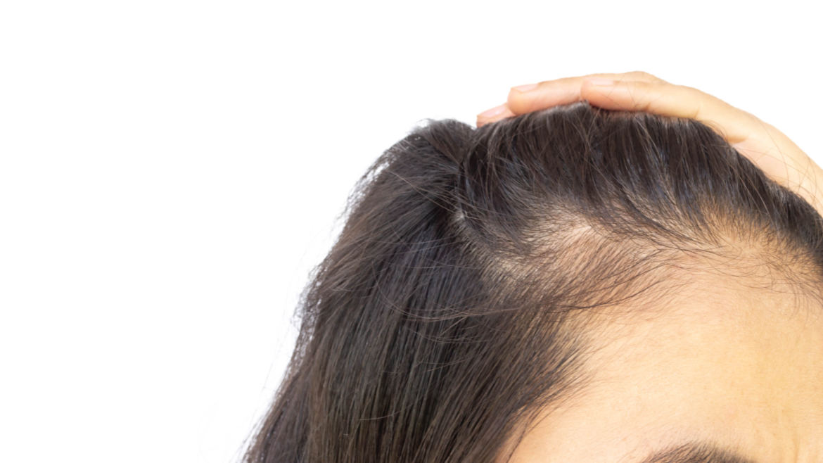 Does the IUD Cause Hair Loss?